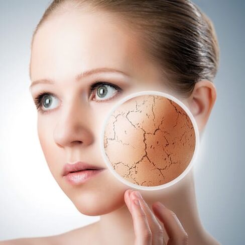 Psoriasis op het gezicht