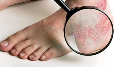 Behandelingsopties voor psoriasis