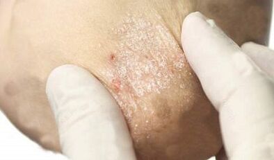 behandeling van psoriasis in de verzwakkingsfase