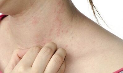 behandeling van psoriasis in een vergevorderd stadium