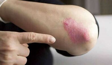 stationaire fase van de ontwikkeling van psoriasis