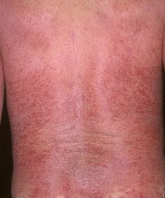 Erytrodermie