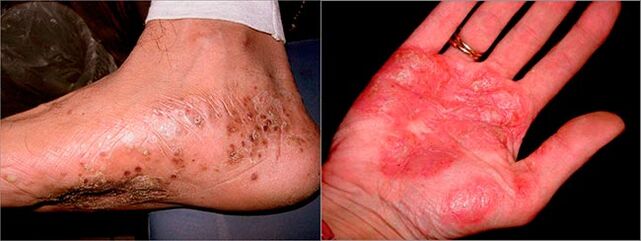 Palmoplantaire psoriasis