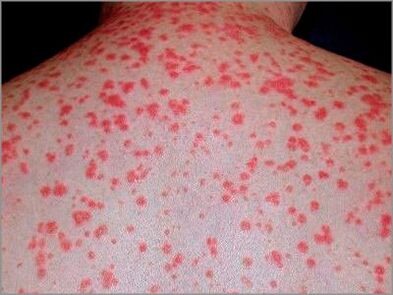 Psoriasis in guttaat