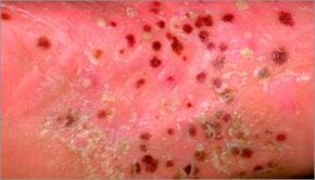 Pustulaire psoriasis