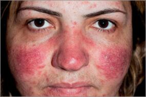 Seborrheische psoriasis