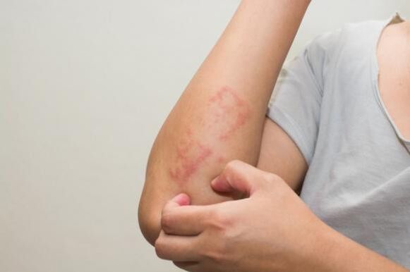 De nieuwste methoden voor het behandelen van psoriasis