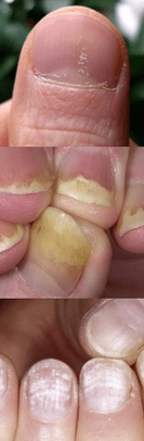 Nagel psoriasis - eerste fase