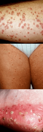 Psoriasis op de benen