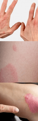 Psoriasis van het beginfase in handen