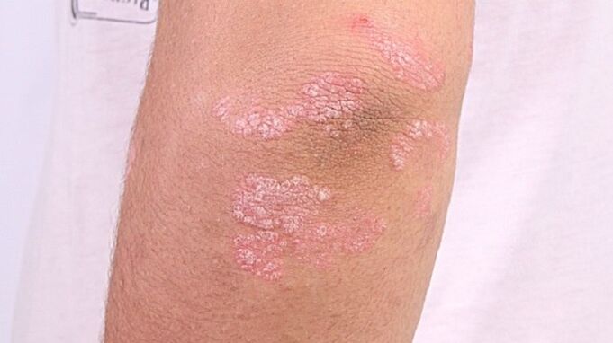 foto van psoriasis in een vroeg stadium