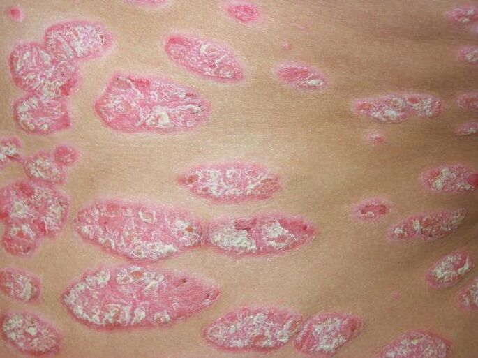 plaque psoriasis