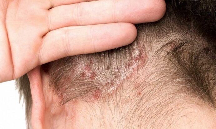 psoriasis op het hoofd