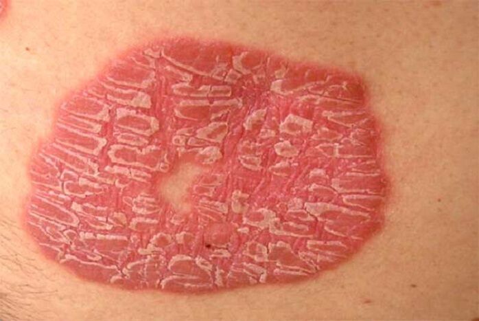 pustuleuze psoriasis