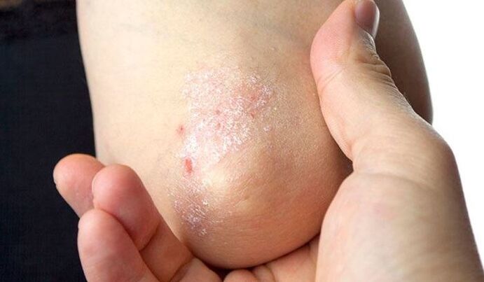 symptomen van psoriasis in de beginfase