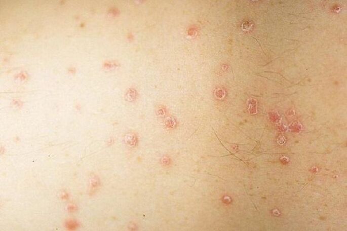 symptomen van spotpsoriasis