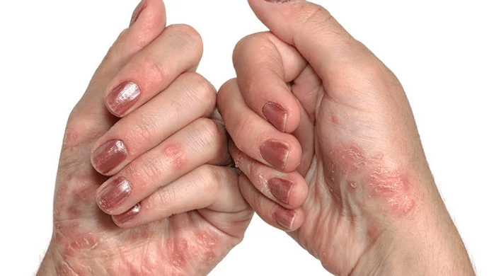 beginstadium van psoriasis
