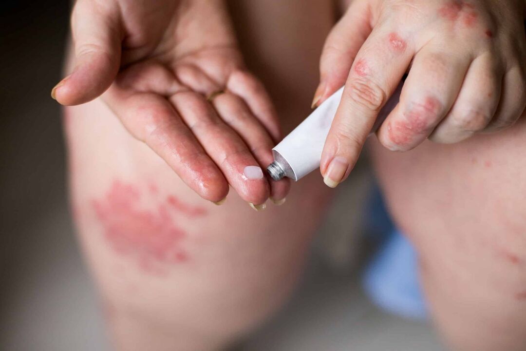 Behandeling van psoriasis