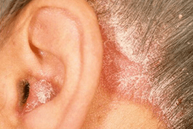 oorzaken van psoriasis