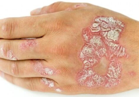 psoriasis bij de hand