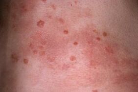 foto van psoriasis op de huid