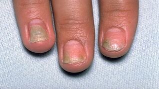 oorzaken van psoriasis op de nagels